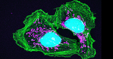 Buňky rakoviny kůže, neasi. Zdroj: NIH Image Gallery
