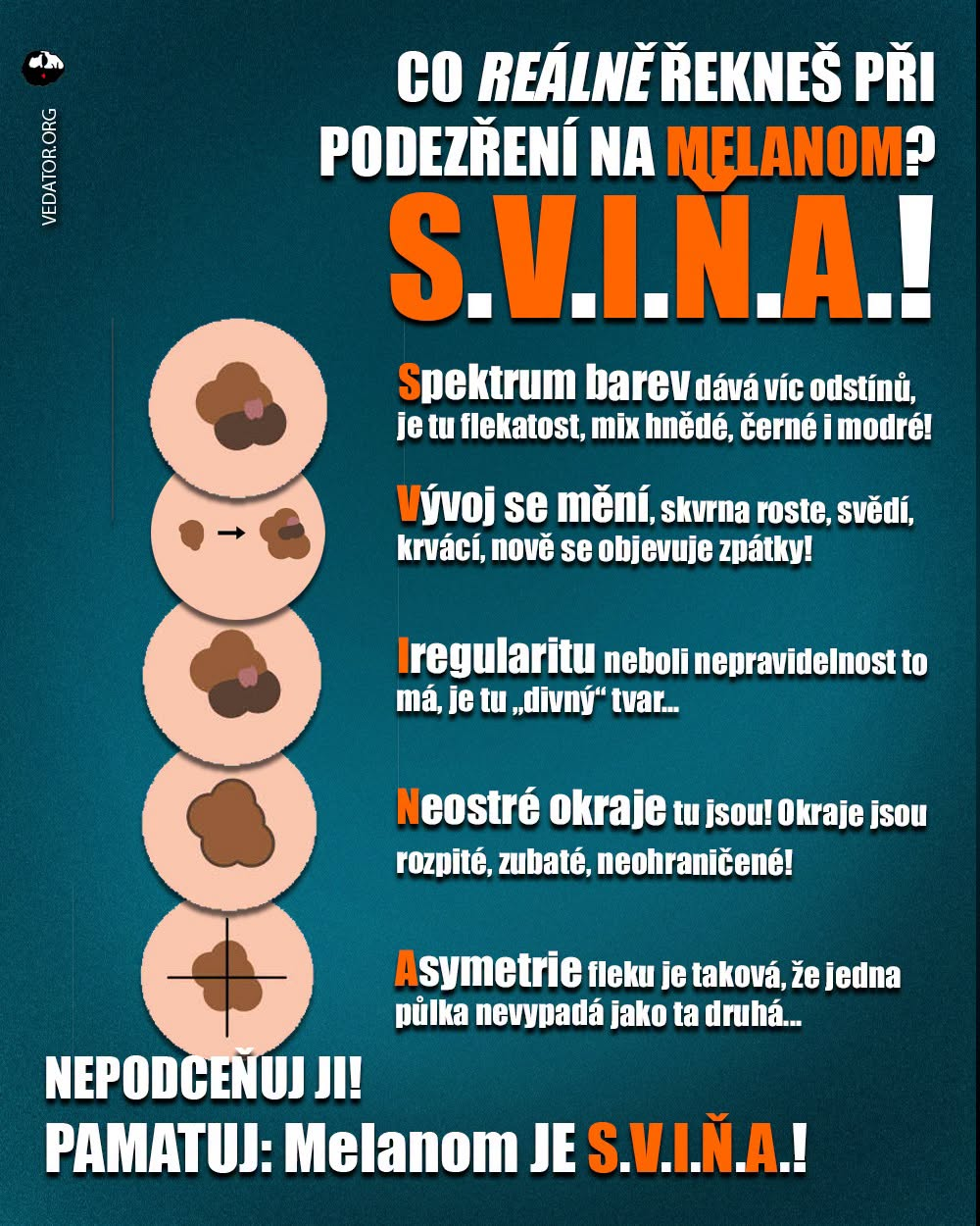 Melanom, rakovina kůže. Zdroj: Vlastní